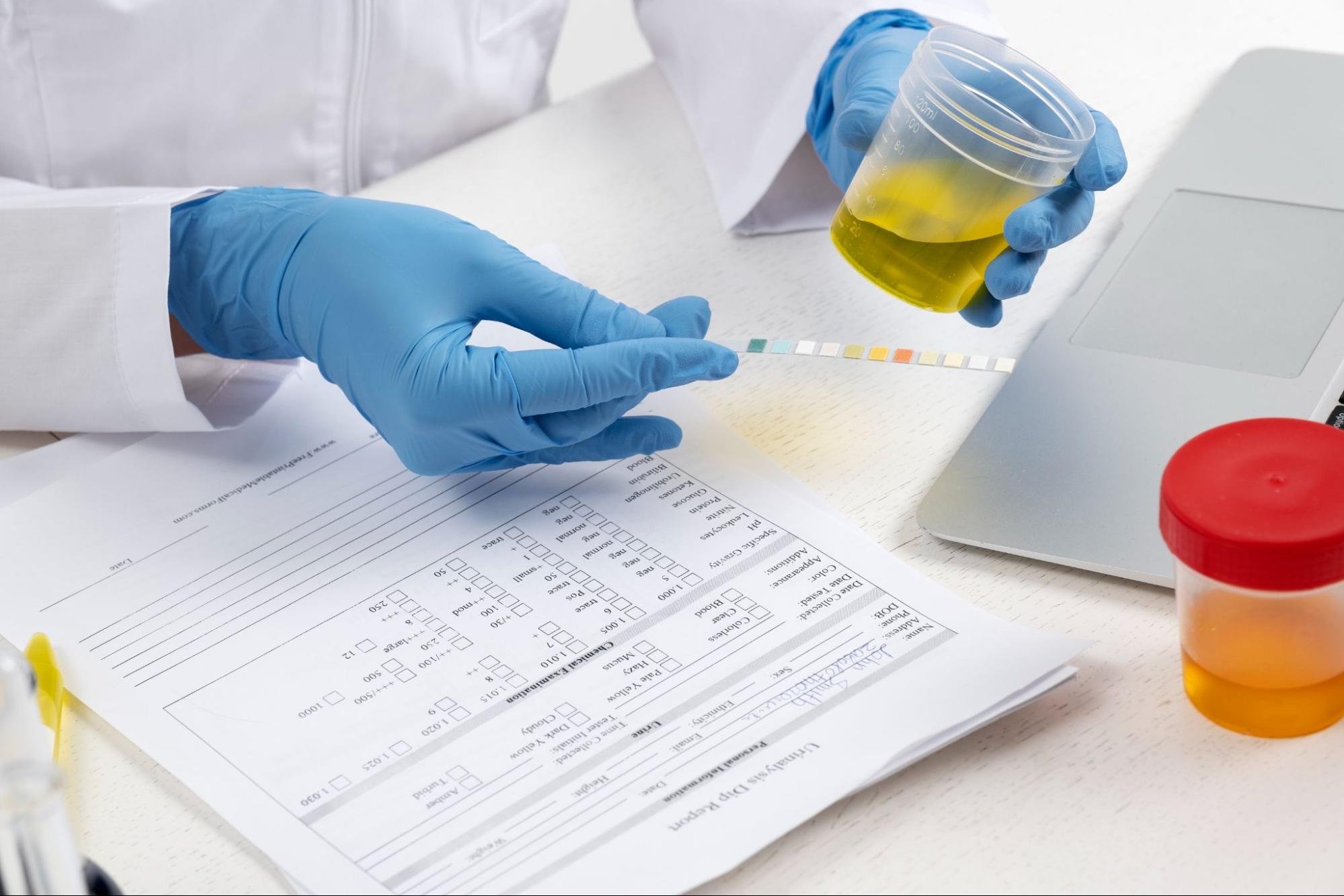 Urine Tests Importance in Kidney Disease Detection